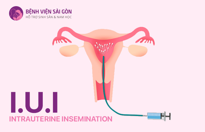 IUI là phương pháp hỗ trợ sinh sản phổ biến điều trị vô sinh hiếm muộn IUI là phương pháp hỗ trợ sinh sản phổ biến điều trị vô sinh hiếm muộn