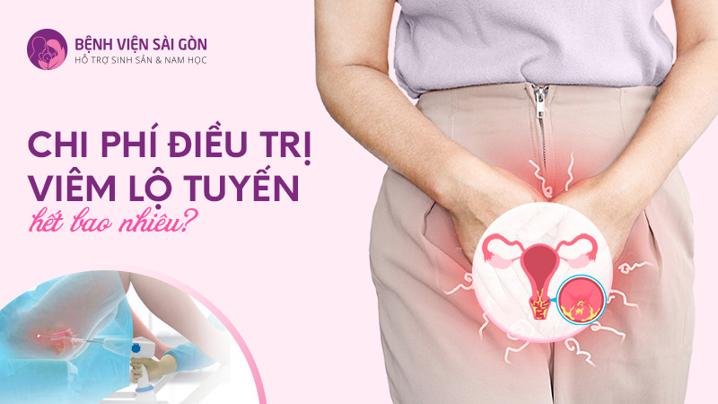 Chi phí điều trị viêm lộ tuyến hết bao nhiêu?