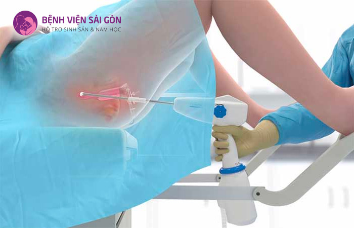 Điều trị viêm lộ tuyến bằng phương pháp đốt lạnh