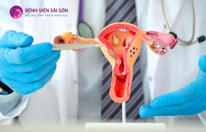 Lạc nội mạc tử cung là một căn bệnh diễn ra âm thầm