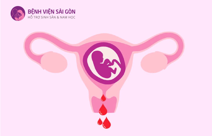 Mức beta hCG tăng chậm có thể cho thấy nguy cơ sảy thai cao
