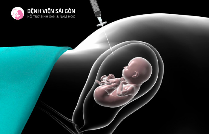 Phương pháp chọc ối được sử dụng để phát hiện những bất thường của NST