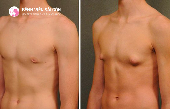 Phương pháp TESE được chỉ định tròn việc tìm tinh trùng cho người mắc hội chứng Klinefelter