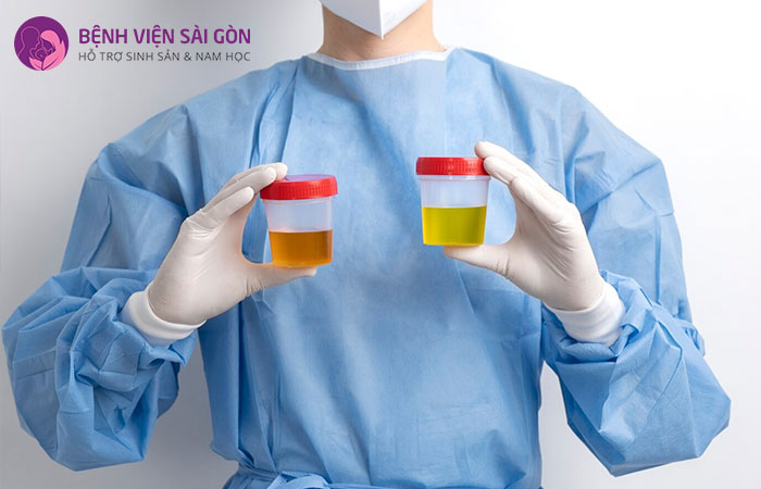 Xét nghiệm nước tiểu giúp chẩn đoán tình trạng xuất tinh ngược