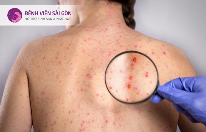Người mẹ mắc bệnh rubella cũng khiến thai chết lưu