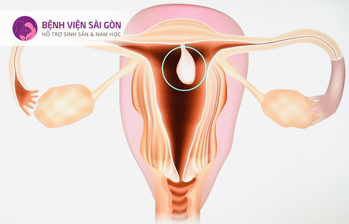 Siêu âm đầu dò giúp phát hiện polyp ở tử cung