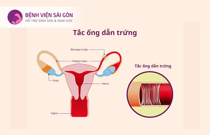 Tắc vòi trứng là tình trạng ống dẫn trứng bị tắc nghẽn