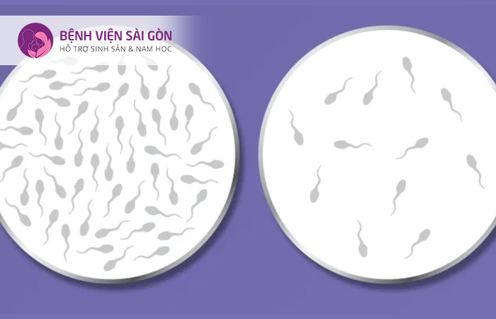 Xét nghiệm tinh dịch đồ tinh phương pháp đem tinh dịch soi dưới kính hiển vi