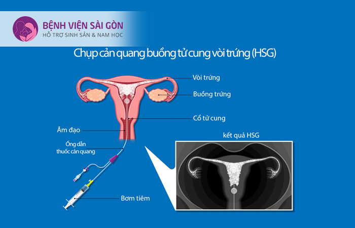 Chụp cản quang là phương pháp hữu hiệu trong chẩn đoán tắc vòitrứng