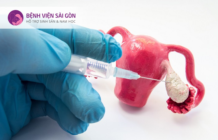 Thuốc kích trứng thường được chỉ định khi sử dụng IUI/IVF
