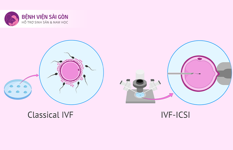 Tìm hiểu IVF là một trong những lưu ý trước khi làm IVF quan trọng