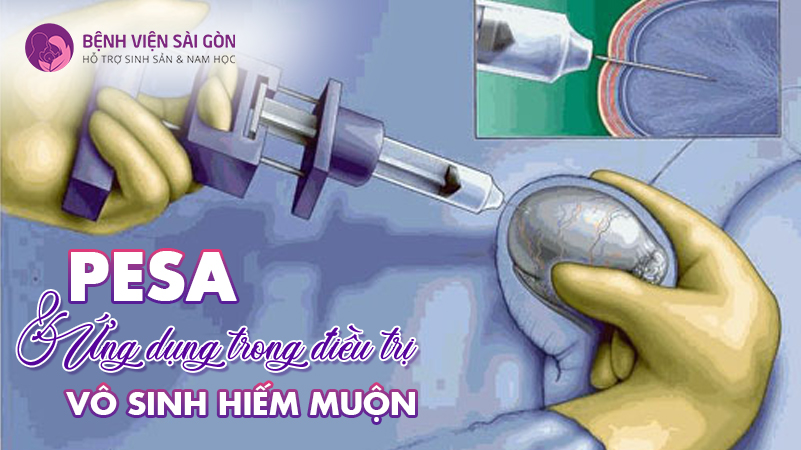 PESA - Phương pháp hỗ trợ tìm con cho nam giới vô tinh