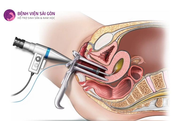 Nội soi buồng tử cung Nội soi buồng tử cung