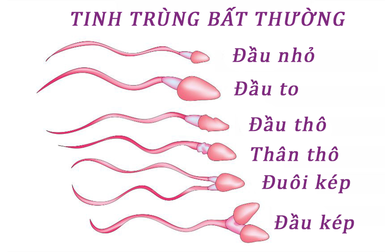 Nam giới có bất thường tinh trùng Nam giới có bất thường tinh trùng